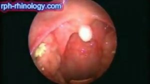 Tonsil Follicle