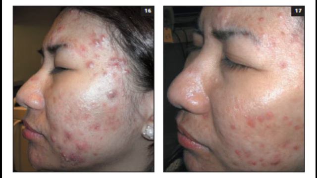 ACNE VULGARIS – CURRENT MEDICAL THERAPEUTICS