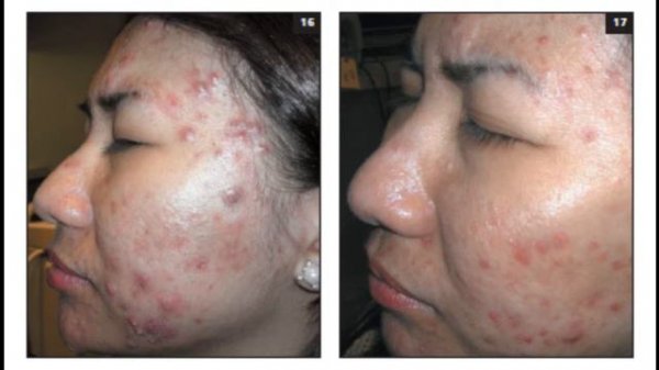 ACNE VULGARIS – CURRENT MEDICAL THERAPEUTICS