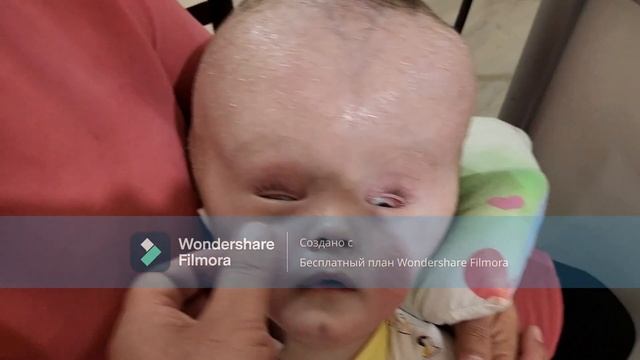 Анэнцефалия (полное отсутствие головного мозга). смотреть онлайн