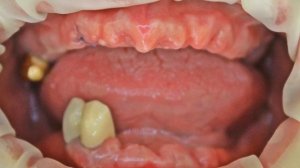 Протезирование съемными протезами верхняя и нижняя челюсть