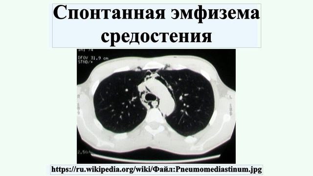Спонтанная эмфизема средостения