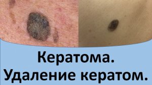 Кератома. Удаление кератом.
