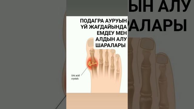 ТАПТЫРМАС ЕМ! ЖЕЛДІ БУЫН ҚАБЫНУ(ПОДАГРА)АУРУЫН ЖЕҢІЛДЕТЕТІН 3 ӘДІС + 1 ТАҒАМДЫҚ ЕМ смотреть онлайн