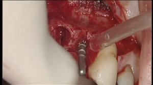 УСТАНОВКА ИМПЛАНТАТА В РАСШИРЕННОМ БЕЗЗУБОМ ПРОСТРАНСТВЕ.ОДНОМОМЕНТНАЯ ИМПЛАНТАЦИЯ С УВЕЛИЧЕНИЕМ ОБ