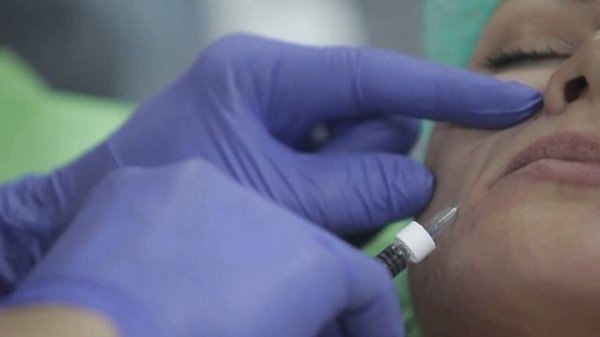 Коррекция носогубной складки Regenyal IDEA