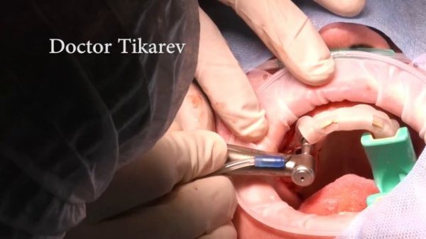 Straumann  guide surgery Установка имплантатов Straumann BLT