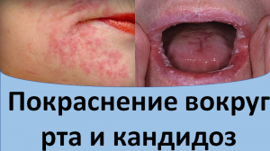 Покраснение вокруг рта и кандидоз.