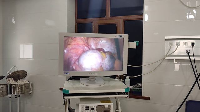 Киста левого яичника смотреть онлайн