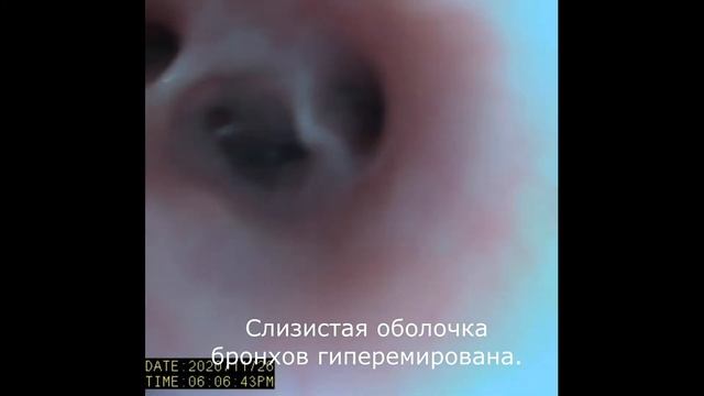 Хронический бронхит, коллапс бронхов у йорка