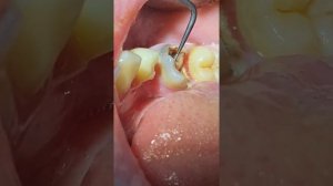 Зуб на удаление