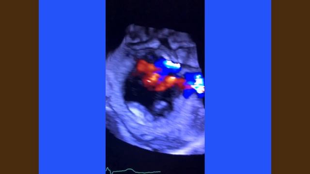 Significant Functional TR / Malcoaptation of TV Leaflets (TTE, TEE,3D) смотреть онлайн