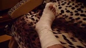 ПЕРЕЛОМ ПЯТКИ/Перелом пяточной кости Скорая помощь/переломы костей