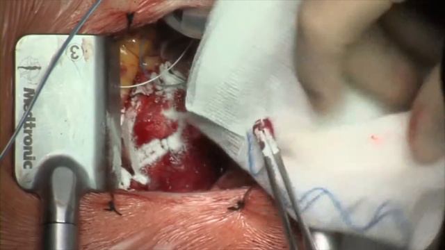 Гемостатический порошок Starsil Hemostat | Auroramed смотреть онлайн