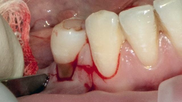 23.04.16. Мария Носова. Практикум по пластике десны. Эпизод 7 смотреть онлайн