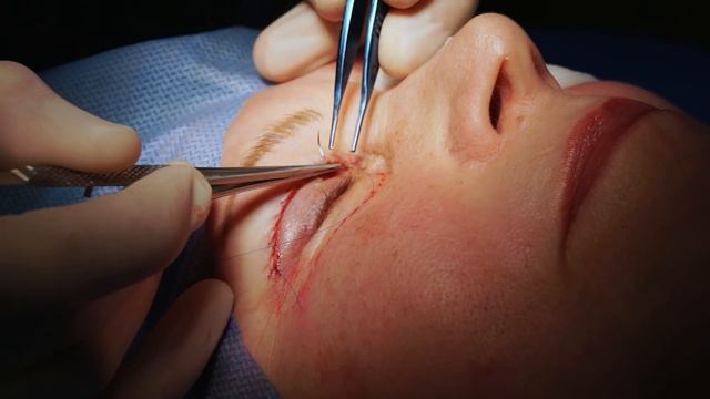 Верхняя блефаропластика и комбинированный глубокий пилинг нижних век по технологии TIMED смотреть онлайн