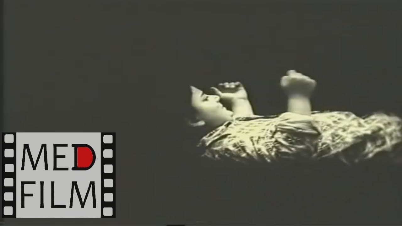 Эпиприпадки - фокальные (парциальные), эпилепсия © EPILEPSY, Focal (partial) epimetriosis смотреть онлайн