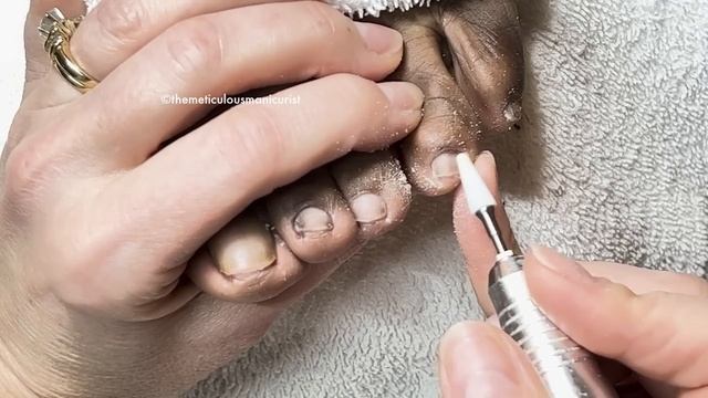 ?How to Fix Toenail Discomfort? смотреть онлайн
