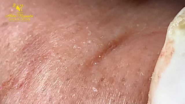 Satisfying And Relax Video With Hien Spa Beauty #01
