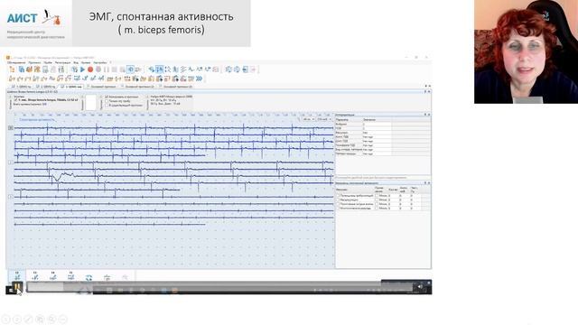 Тема: Миография при травматическом повреждении периферических нервов. смотреть онлайн
