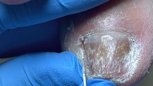 Very Hard Onychomycosis, Use Pliers To Eliminate Them【Pedicure Master Lin Jun】