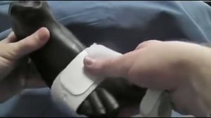 Смотреть Шишка На Большом Пальце Ноги - Наросты На Пальцах Ног