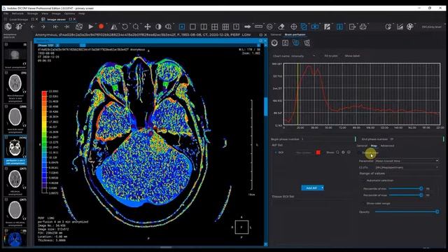 CT Brain perfusion estimation in Inobitec DICOM Viewer Pro 2.5 смотреть онлайн