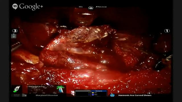Live lymph node dissection and lobectomy on 10:00 смотреть онлайн