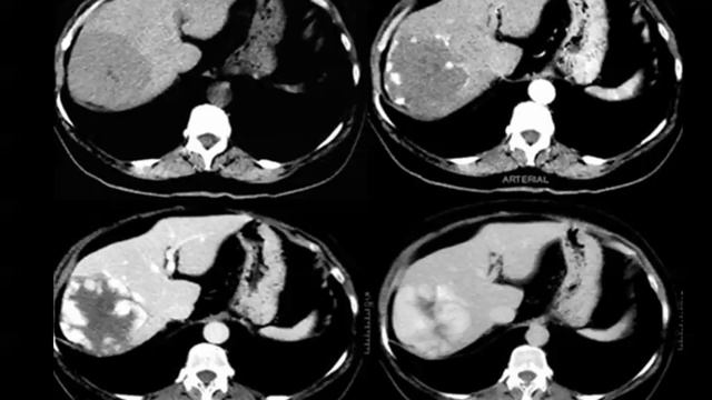 GIT radiology (hepatic imaging) | Prof. Mamdouh Mahfouz смотреть онлайн