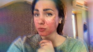 ПИЛИНГ ДЖЕССНЕРА/ ВОССТАНОВЛЕНИЕ