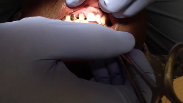 Gold Anterior Crown Occlusion Check смотреть онлайн