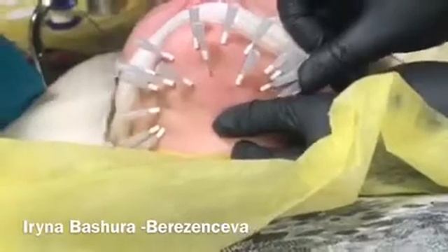 Коррекция подбородка смотреть онлайн