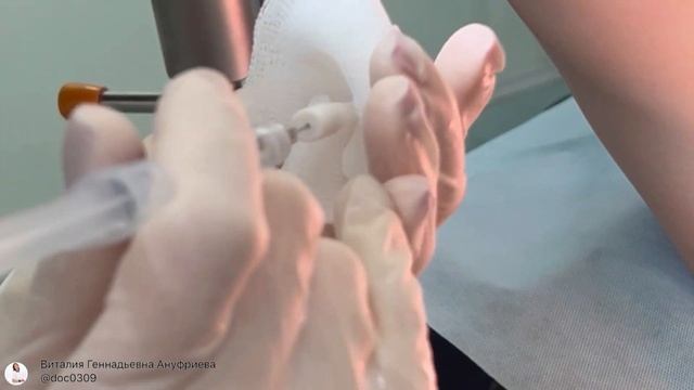 Установка ворд-катетера (катетера Ворда) смотреть онлайн