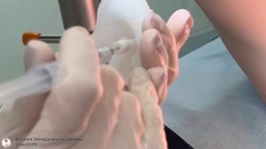 Установка ворд-катетера (катетера Ворда)