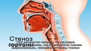 Признаки ложного крупа у ребенка