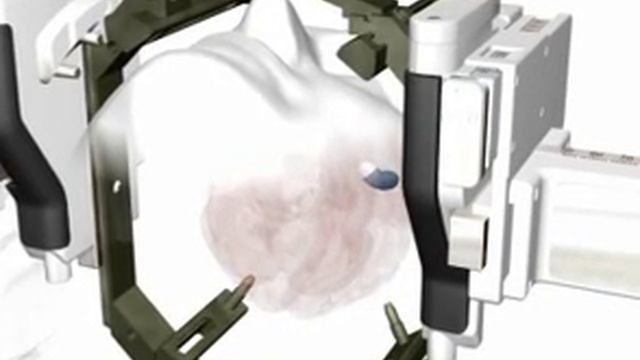 Как работает «Гамма-нож» смотреть онлайн