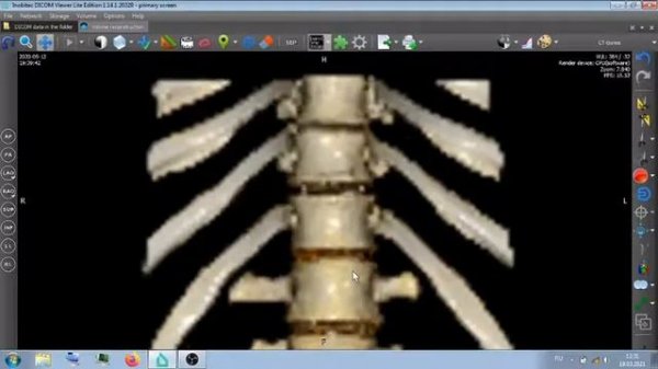 ПОЯСНИЧНЫЙ ОТДЕЛ КТ .