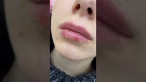 Осложнение после контурной пластики губ