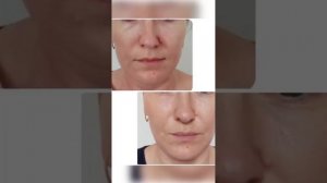 Botox Full Face: до и после