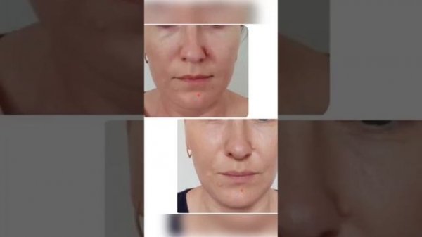 Botox Full Face: до и после