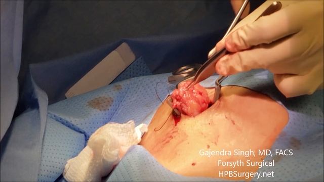 Benign Breast Mass Excision смотреть онлайн