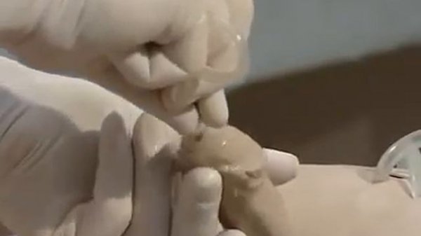 Установка и использование катетера Фолея