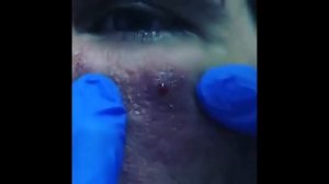 ВЫДАВЛИВАНИЕ ЧИРИЯ ПОД ГЛАЗОМ У ПАРНЯ. ПОЛ-ЛИТРА ГНОЯ!!!