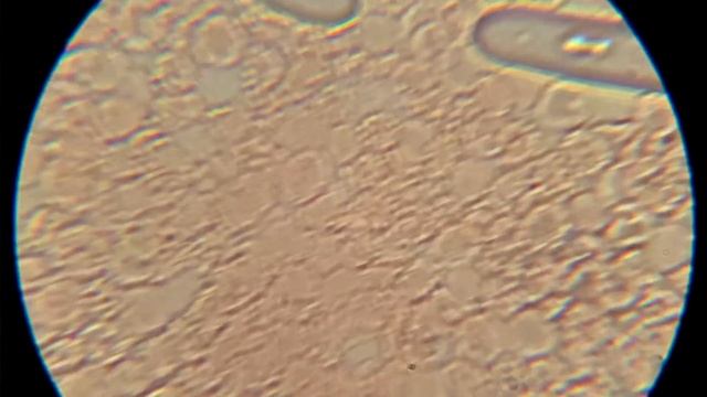 КРОВЬ ПОСЛЕ ЯДА ПЧЕЛЫ смотреть онлайн