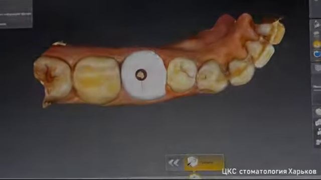 Немедленная имплантация зубов с Sirona