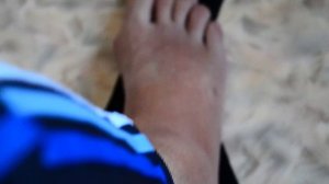 РАСТЯЖЕНИЕ ГОЛЕНОСТОПНОГО СУСТАВА! ЧАСТИЧНЫЙ РАЗРЫВ СВЯЗОК ГОЛЕНОСТОПА!