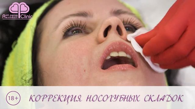коррекция носогубных складок смотреть онлайн