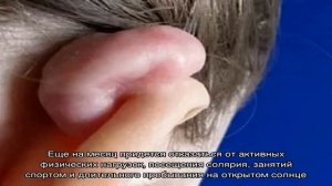 Как проходит реабилитация после отопластики