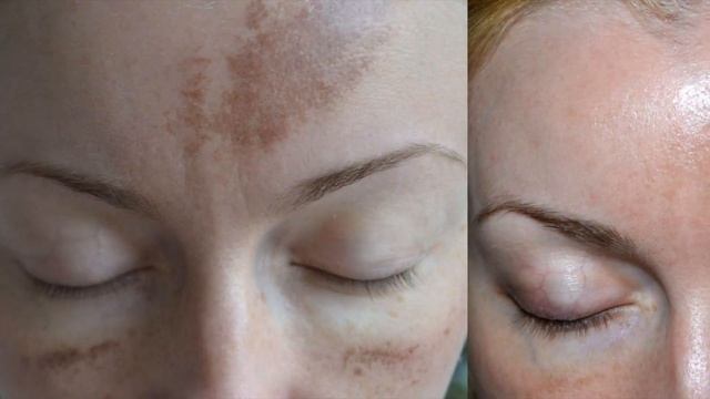 Удаляем Пятна на Лице Раз и Навсегда?