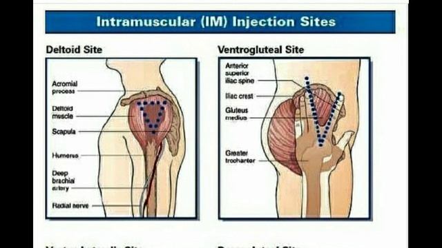 Intramuscular (IM) Injection Sites смотреть онлайн
